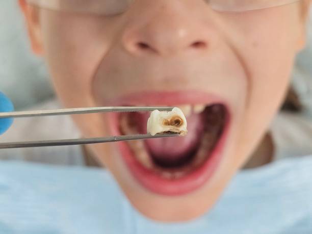 Best Emergency Dentist for Knocked-Out Tooth in Grand Bay, AL