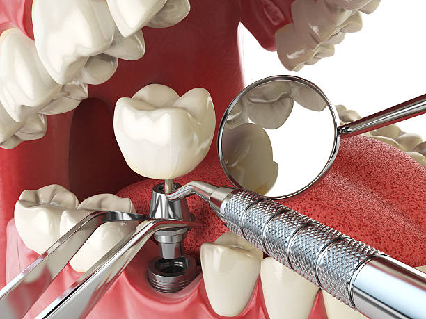 Best Emergency Dental Extractions in Grand Bay, AL
